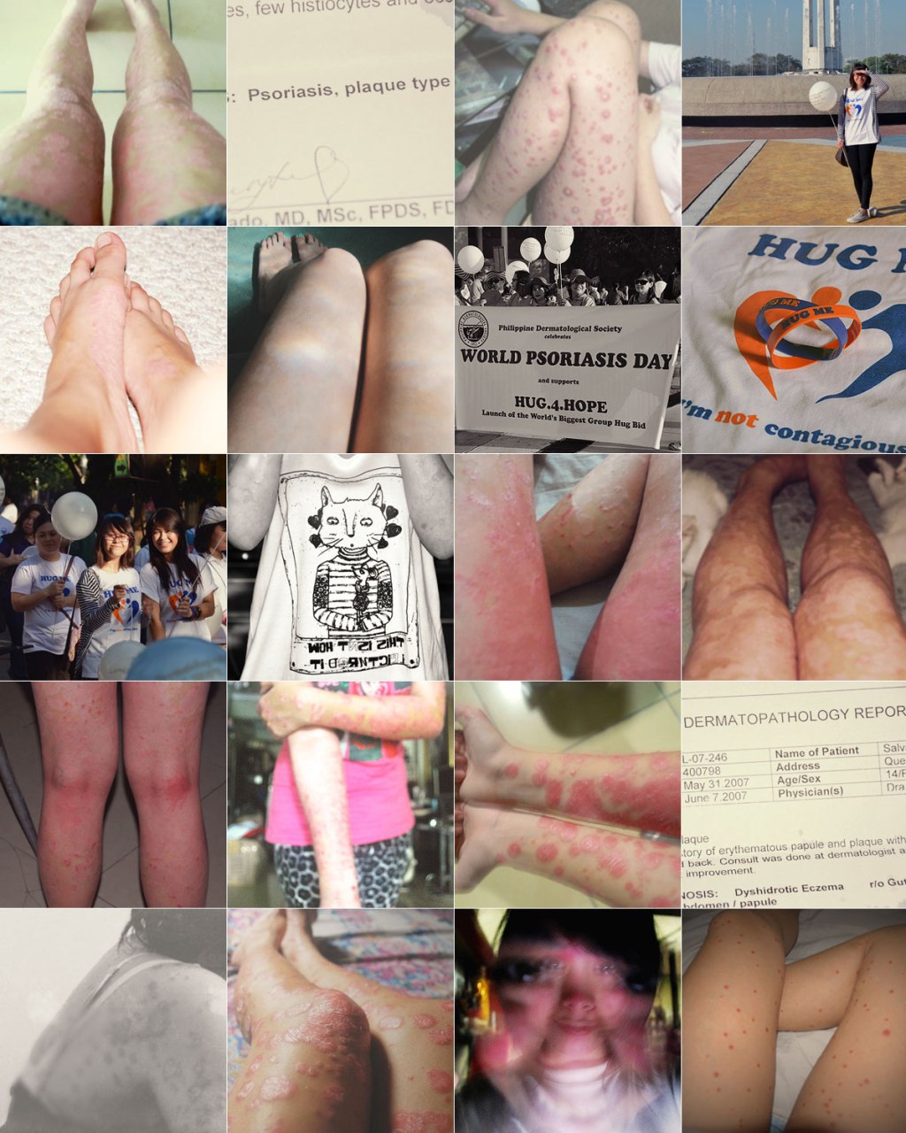 Living with Psoriasis